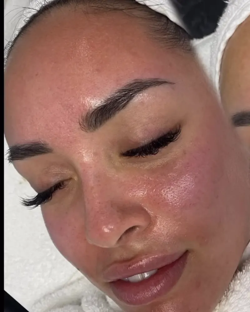 Gesicht direkt nach dem Microneedling: gleichmäßig durchblutete, glatte Haut