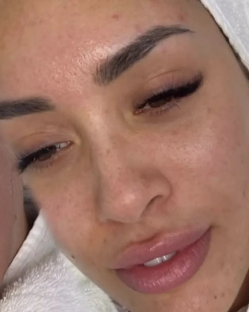 Gesicht vor dem Microneedling: Wangen mit kleinen Unreinheiten und ungleichmäßigem Hautbild